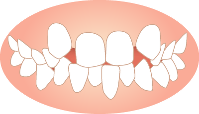 叢生（そうせい） | 症例別 | 周南市：透明マウスピース矯正「インビザライン」