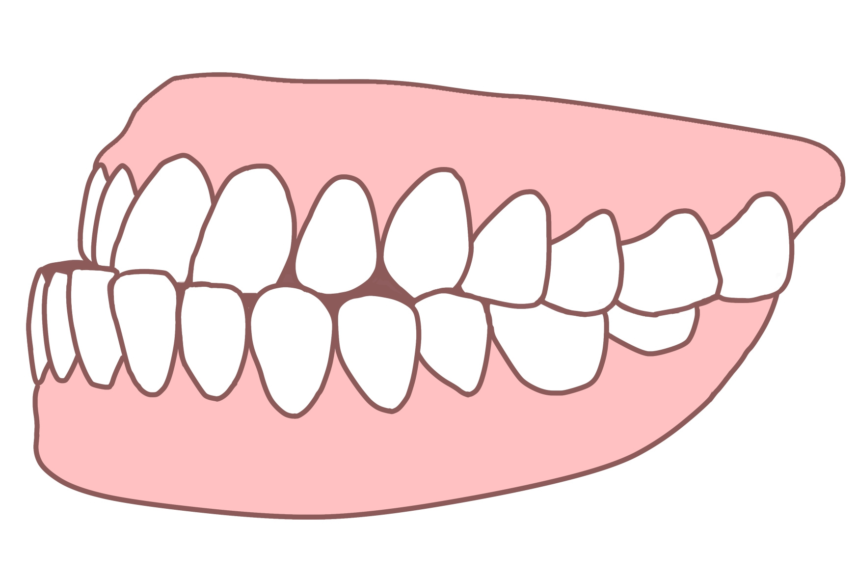 受け口のイラスト